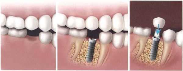 پر کردن جای خالی دندان با ایمپلنت